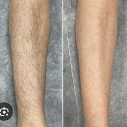 Professional All-Body Sugaring Hair Removal for Sensitive Skin in Long Island City, NY